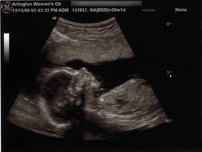 Abortion Ultrasound