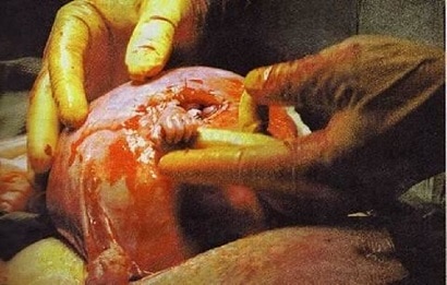 Abortion The Tiny Hand of 21-week-old fetus